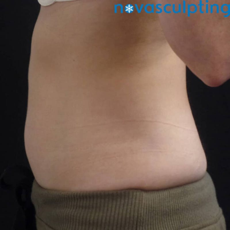 Abdomen Before & After Gallery - Patient 133024817 - Image 3