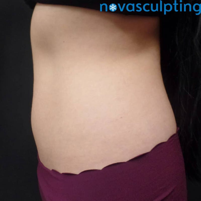 Abdomen Before & After Gallery - Patient 133024817 - Image 4