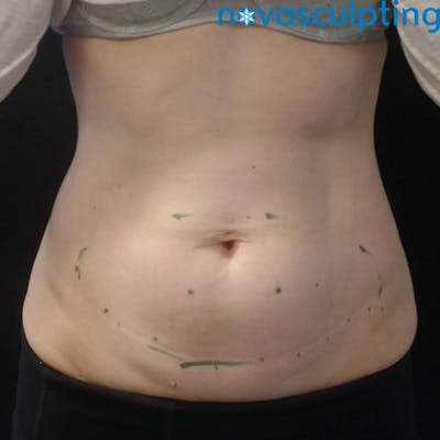 Abdomen Before & After Gallery - Patient 133024819 - Image 1