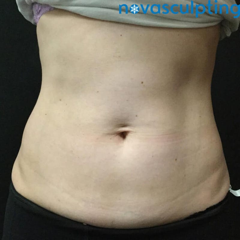 Abdomen Before & After Gallery - Patient 133024819 - Image 2