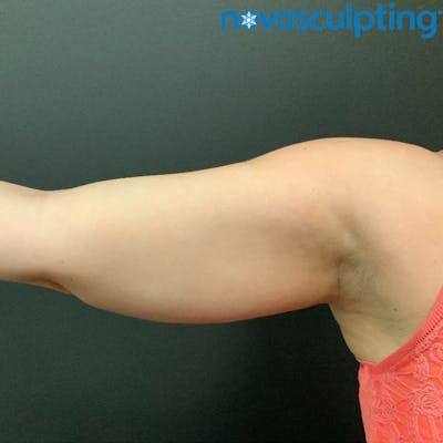 Arms Before & After Gallery - Patient 133024821 - Image 1