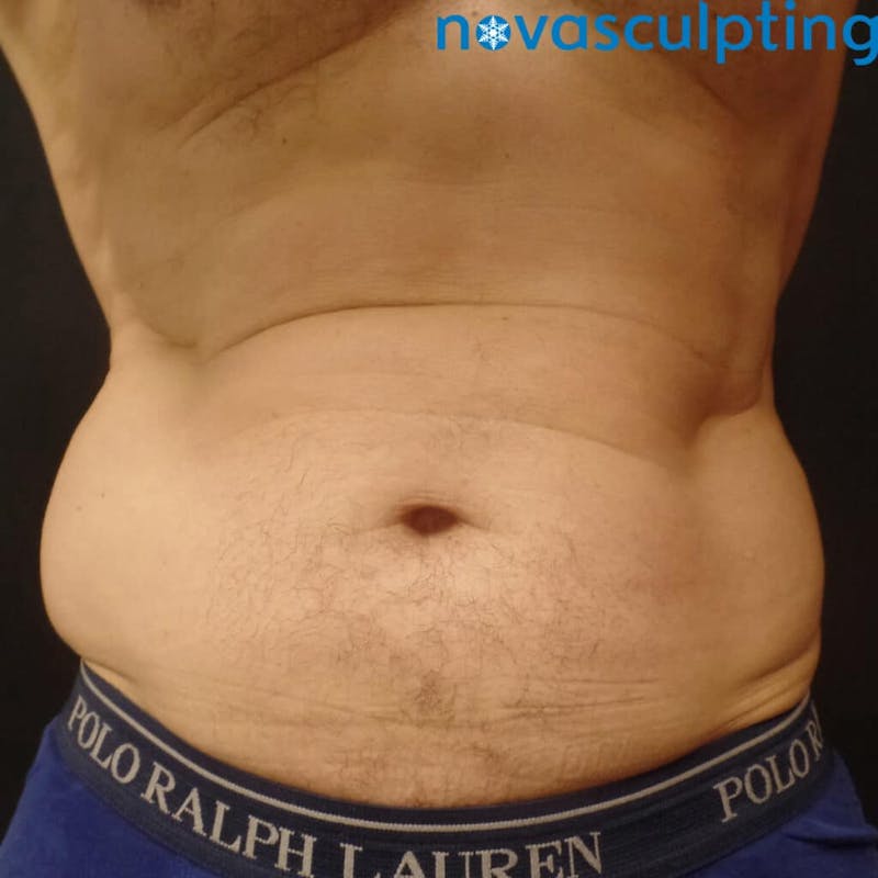 Abdomen Before & After Gallery - Patient 133024824 - Image 1