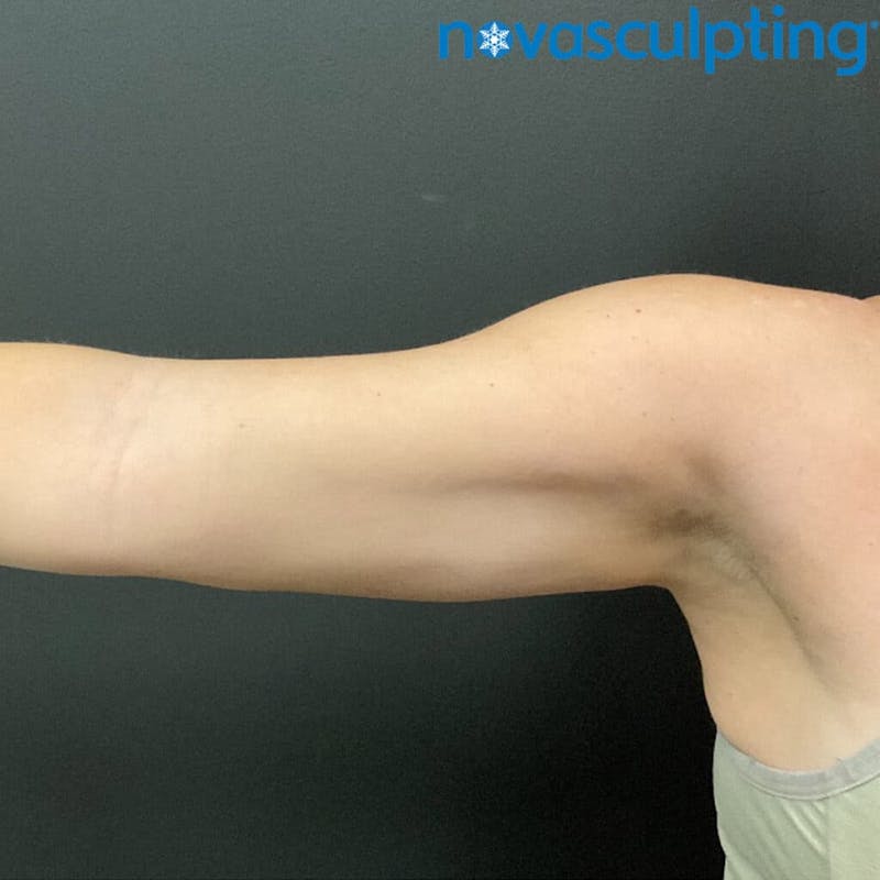 Arms Before & After Gallery - Patient 133024821 - Image 2