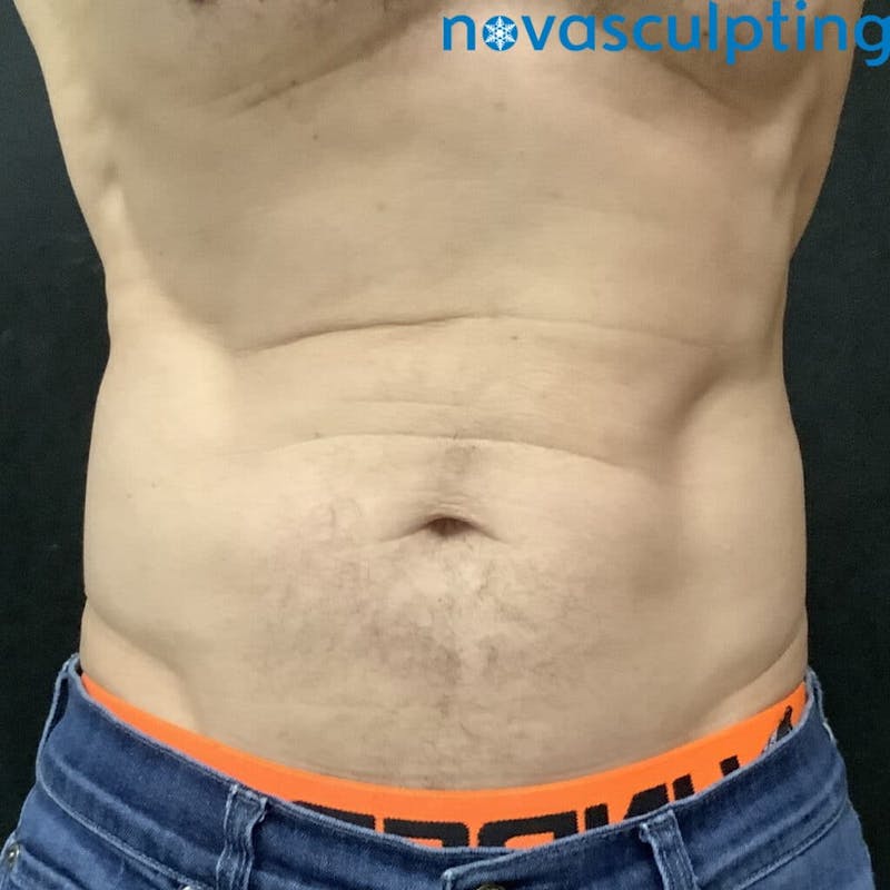 Abdomen Before & After Gallery - Patient 133024824 - Image 2