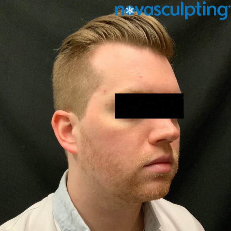 Double Chin Before & After Gallery - Patient 133024823 - Image 1