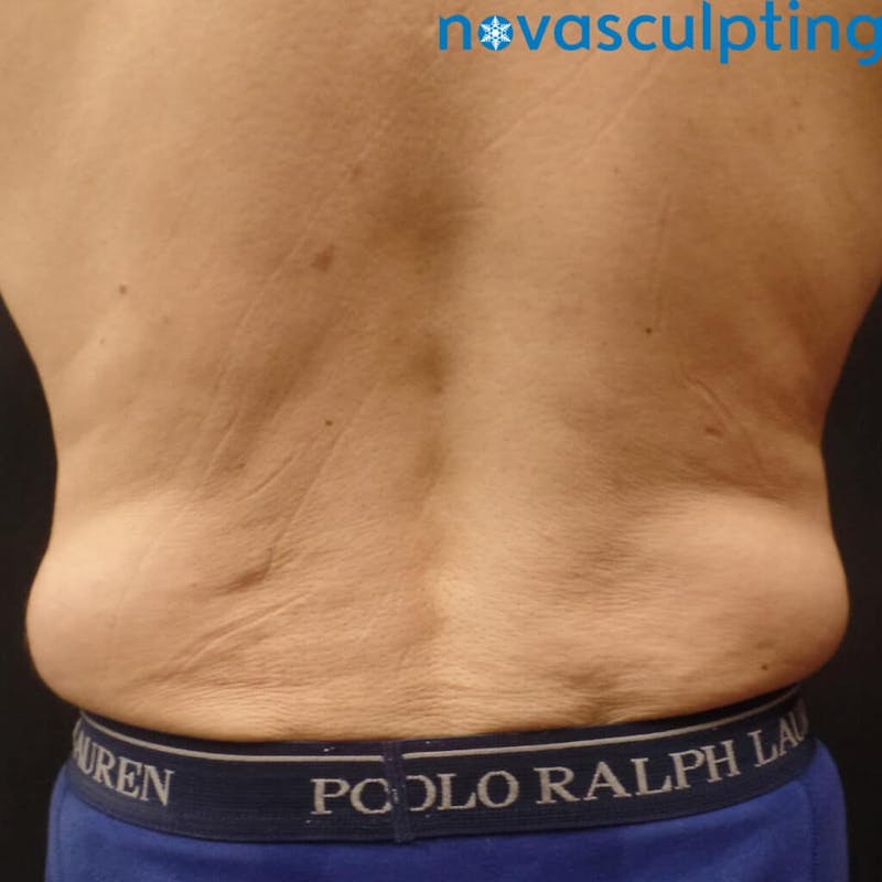 Abdomen Before & After Gallery - Patient 133024824 - Image 5