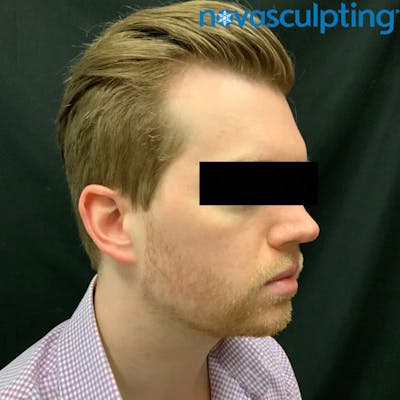 Double Chin Before & After Gallery - Patient 133024823 - Image 2