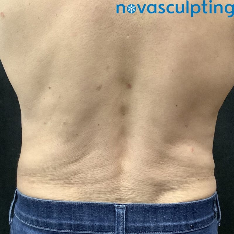 Abdomen Before & After Gallery - Patient 133024824 - Image 6