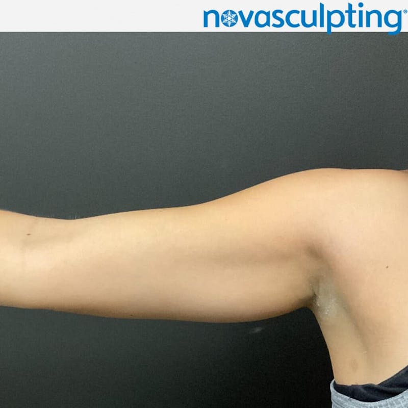 Arms Before & After Gallery - Patient 133024825 - Image 2