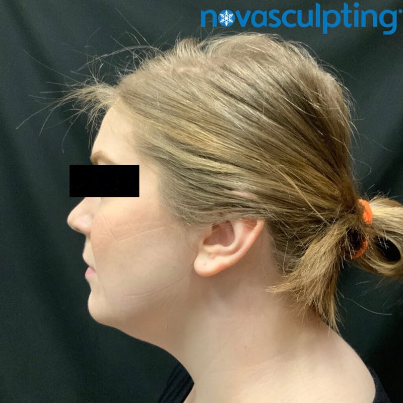 Double Chin Before & After Gallery - Patient 133024829 - Image 1
