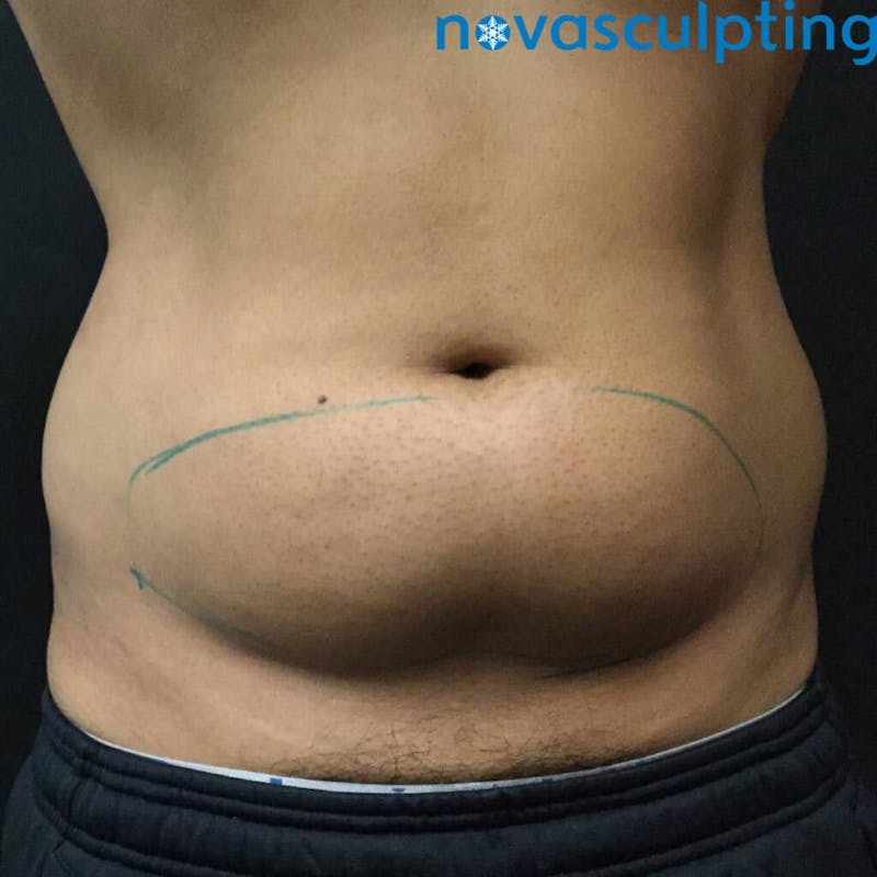 Abdomen Before & After Gallery - Patient 133024827 - Image 1