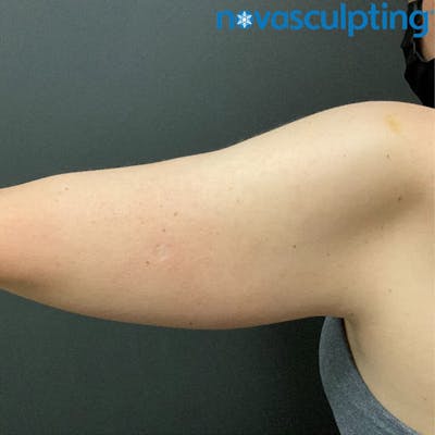 Arms Before & After Gallery - Patient 133024826 - Image 1