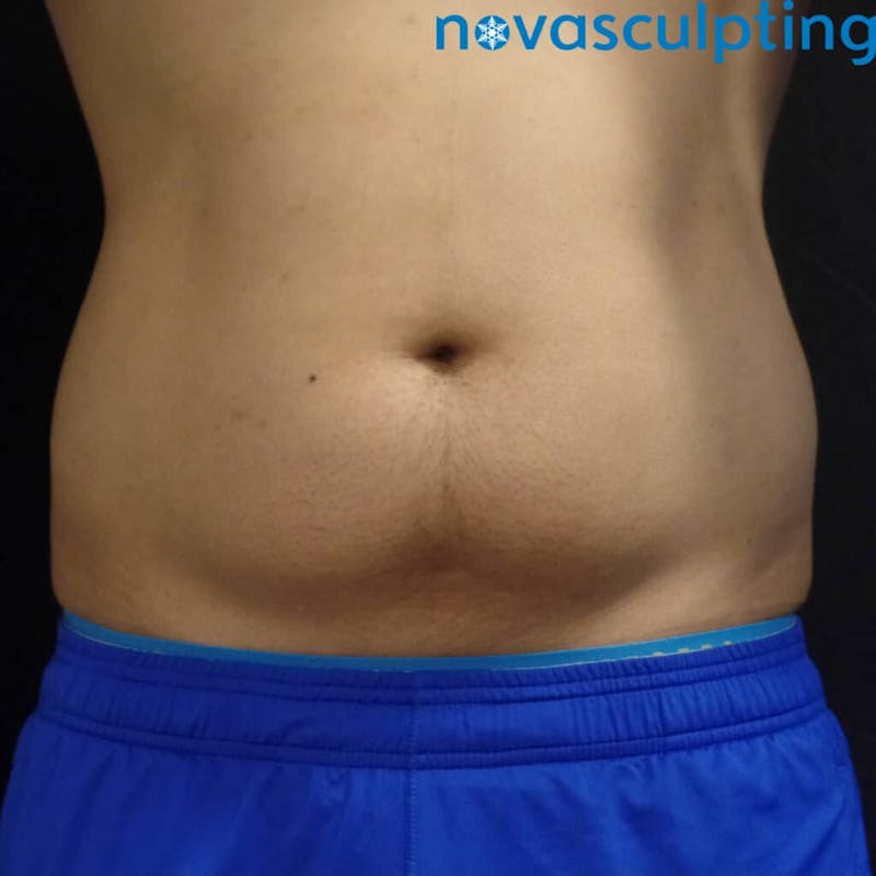 Abdomen Before & After Gallery - Patient 133024827 - Image 2