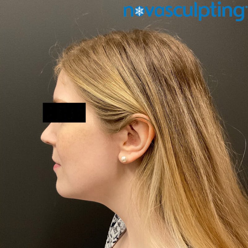 Double Chin Before & After Gallery - Patient 133024829 - Image 2