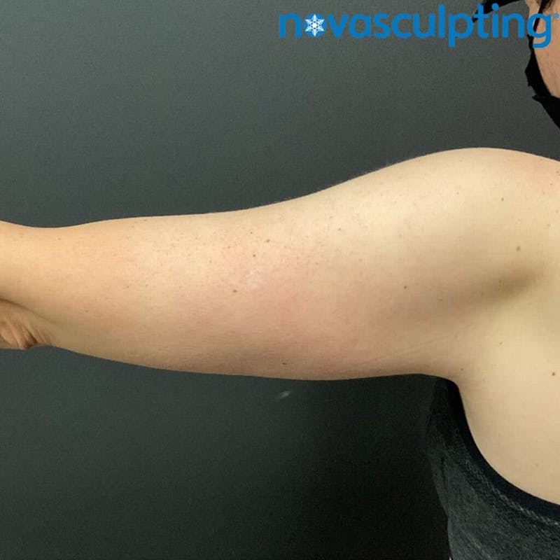 Arms Before & After Gallery - Patient 133024826 - Image 2