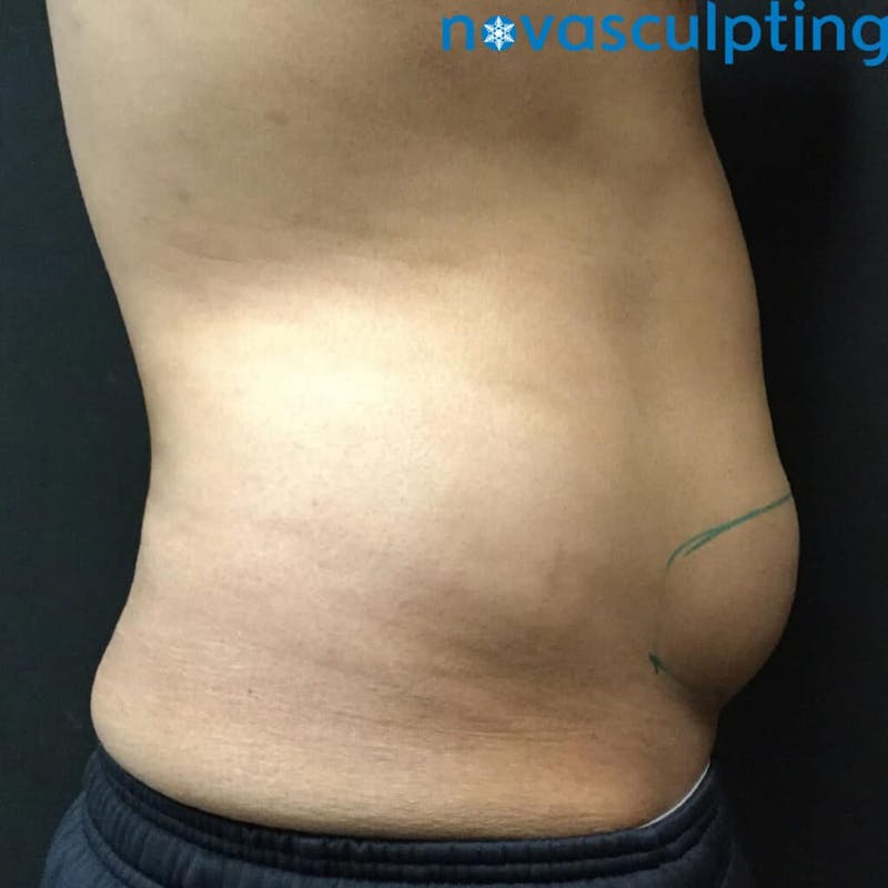 Abdomen Before & After Gallery - Patient 133024827 - Image 3
