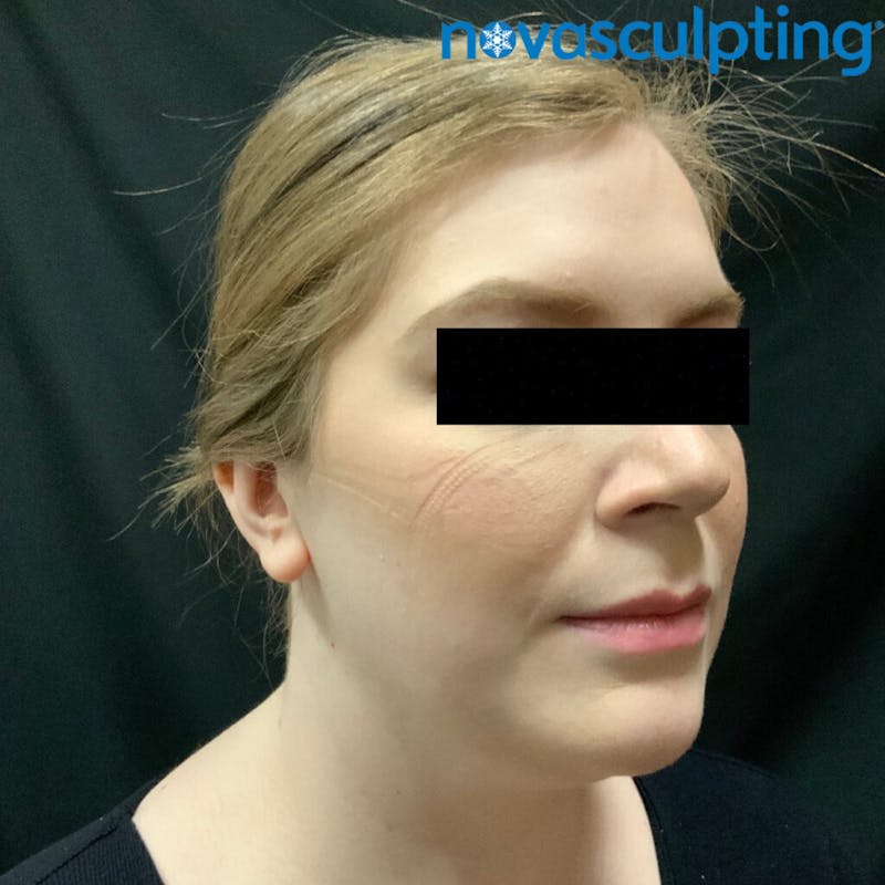 Double Chin Before & After Gallery - Patient 133024829 - Image 3