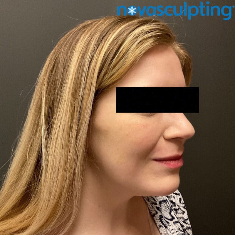 Double Chin Before & After Gallery - Patient 133024829 - Image 4