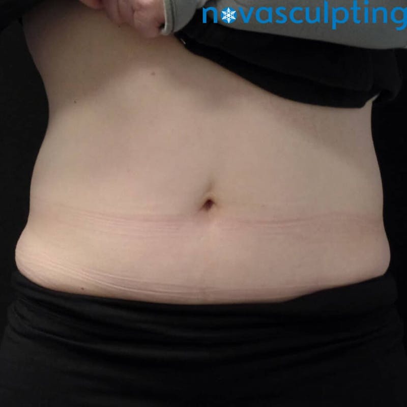 Abdomen Before & After Gallery - Patient 133024831 - Image 1