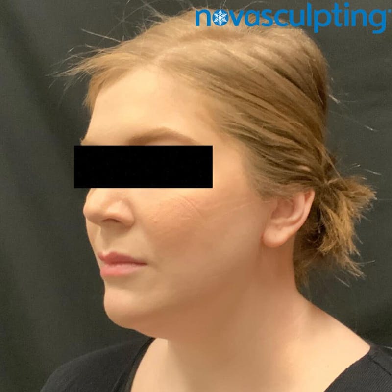 Double Chin Before & After Gallery - Patient 133024829 - Image 5