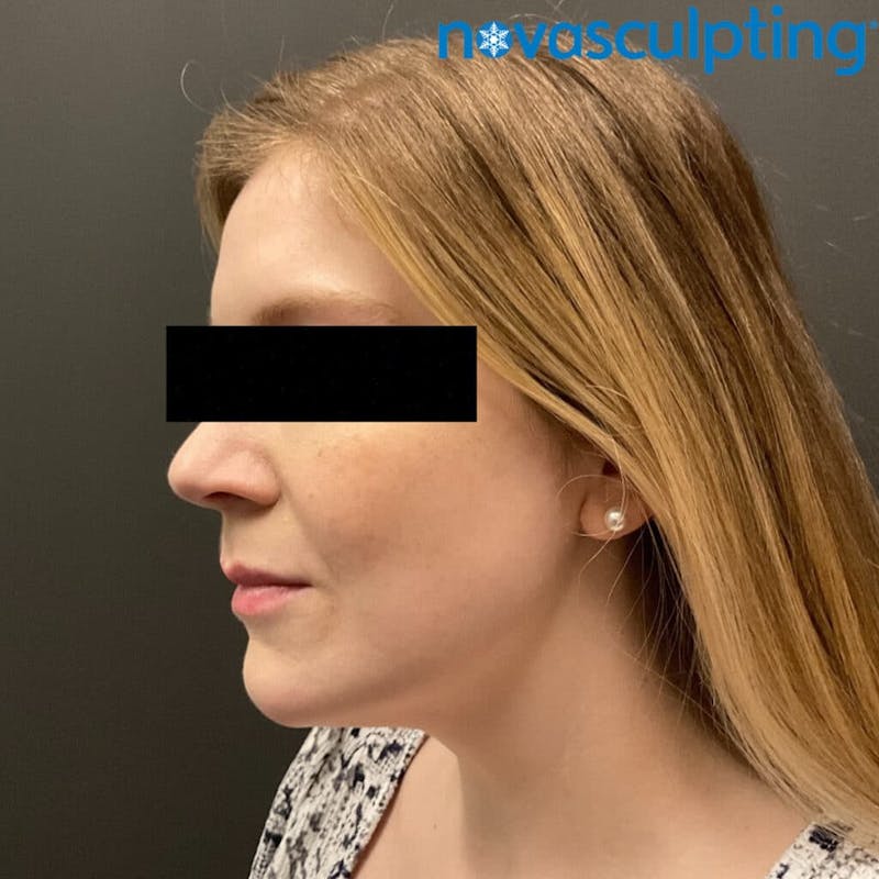 Double Chin Before & After Gallery - Patient 133024829 - Image 6