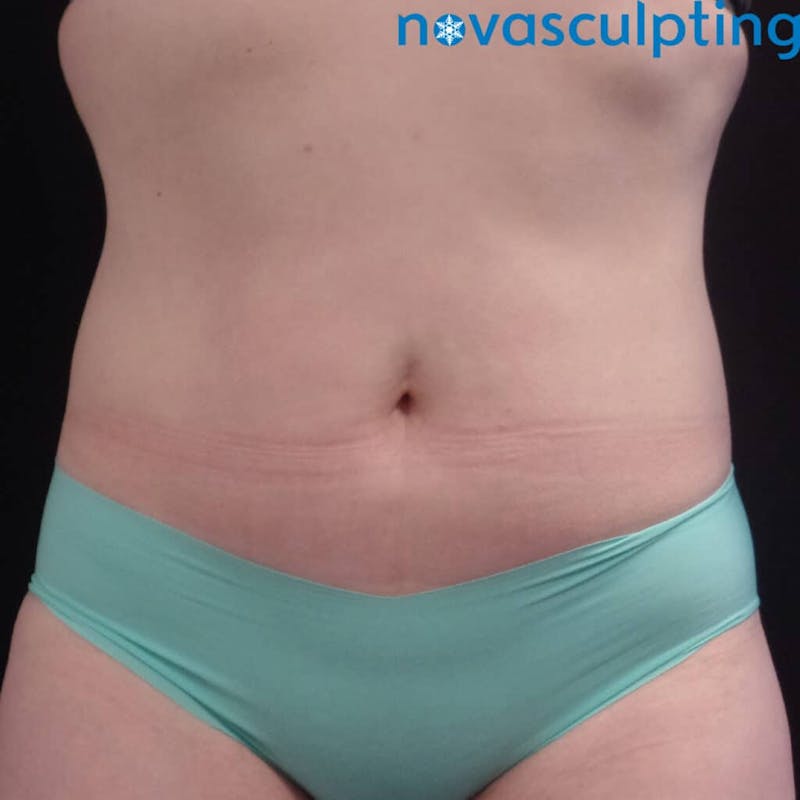 Abdomen Before & After Gallery - Patient 133024831 - Image 2