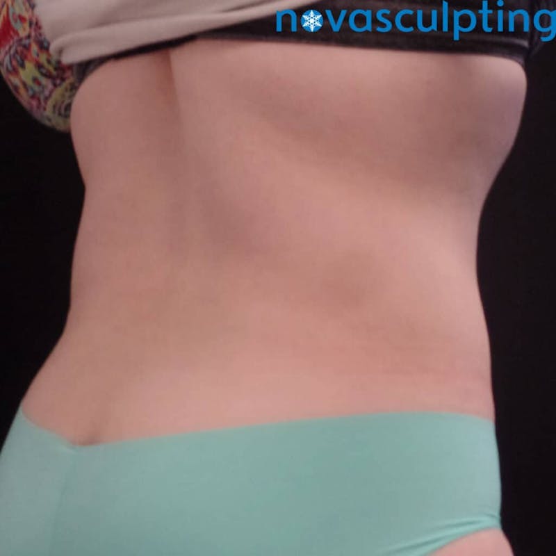 Abdomen Before & After Gallery - Patient 133024831 - Image 4