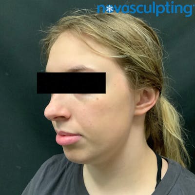 Double Chin Before & After Gallery - Patient 133024833 - Image 1