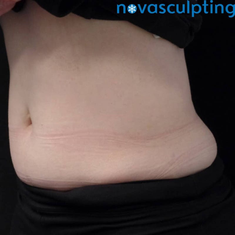 Abdomen Before & After Gallery - Patient 133024831 - Image 5