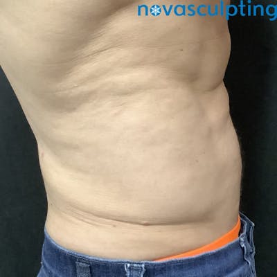 Love Handles Before & After Gallery - Patient 133024832 - Image 2