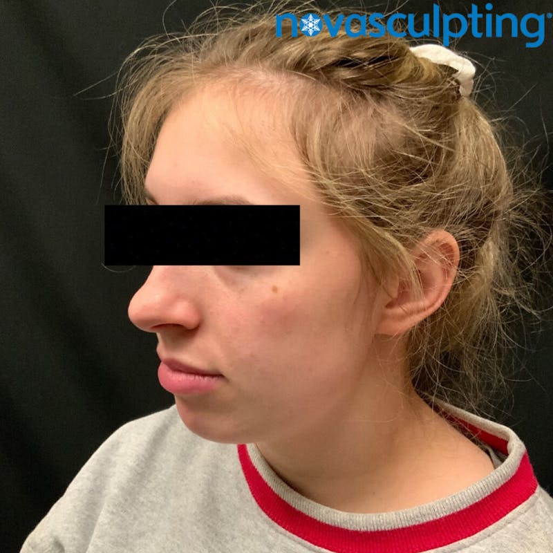 Double Chin Before & After Gallery - Patient 133024833 - Image 2
