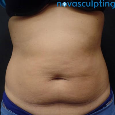 Abdomen Before & After Gallery - Patient 133024836 - Image 1