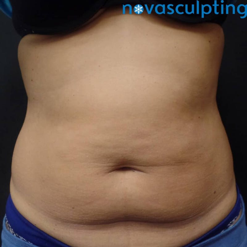 Abdomen Before & After Gallery - Patient 133024836 - Image 1