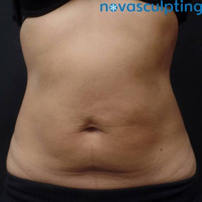 Abdomen Before & After Gallery - Patient 133024836 - Image 2