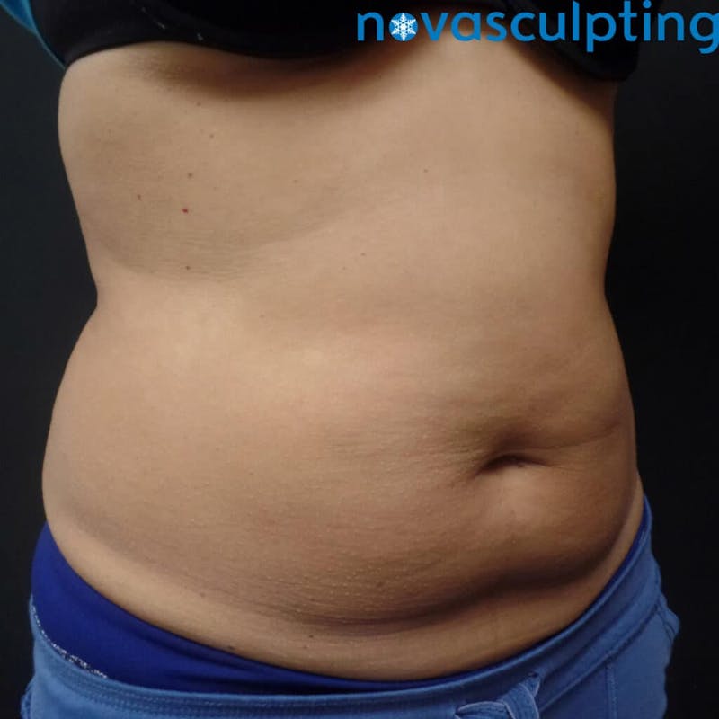 Abdomen Before & After Gallery - Patient 133024836 - Image 3