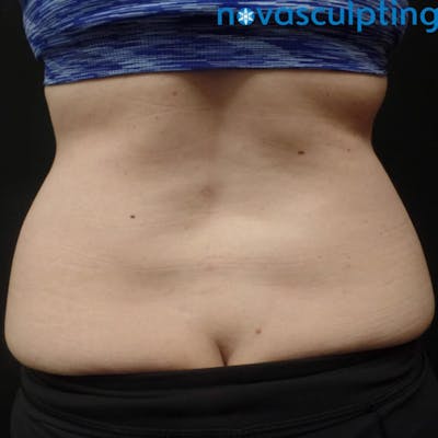 Love Handles Before & After Gallery - Patient 133024835 - Image 1