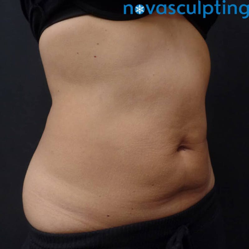 Abdomen Before & After Gallery - Patient 133024836 - Image 4