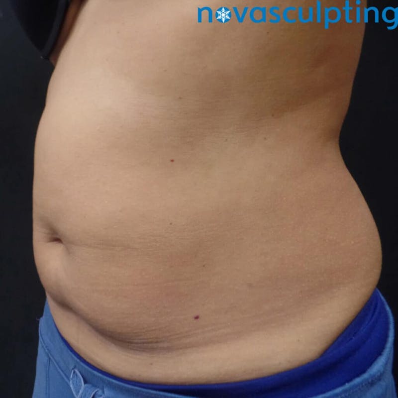 Abdomen Before & After Gallery - Patient 133024836 - Image 5