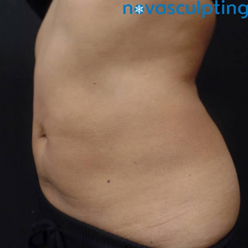 Abdomen Before & After Gallery - Patient 133024836 - Image 6