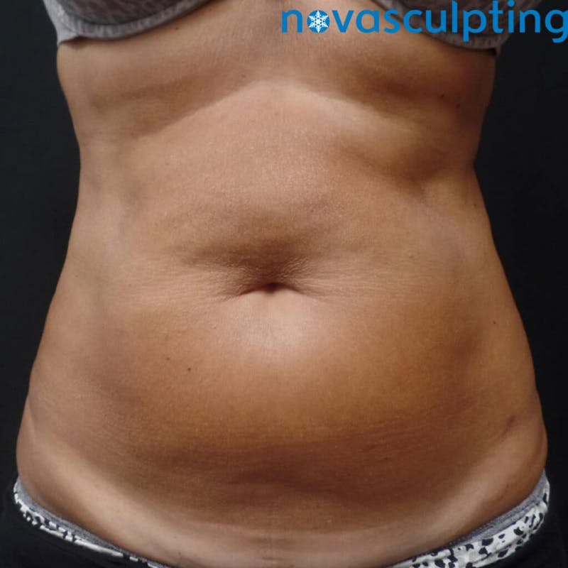 Abdomen Before & After Gallery - Patient 133024838 - Image 1