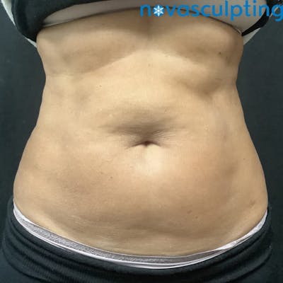 Abdomen Before & After Gallery - Patient 133024838 - Image 2