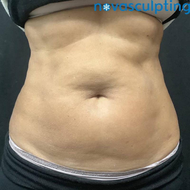 Abdomen Before & After Gallery - Patient 133024838 - Image 2