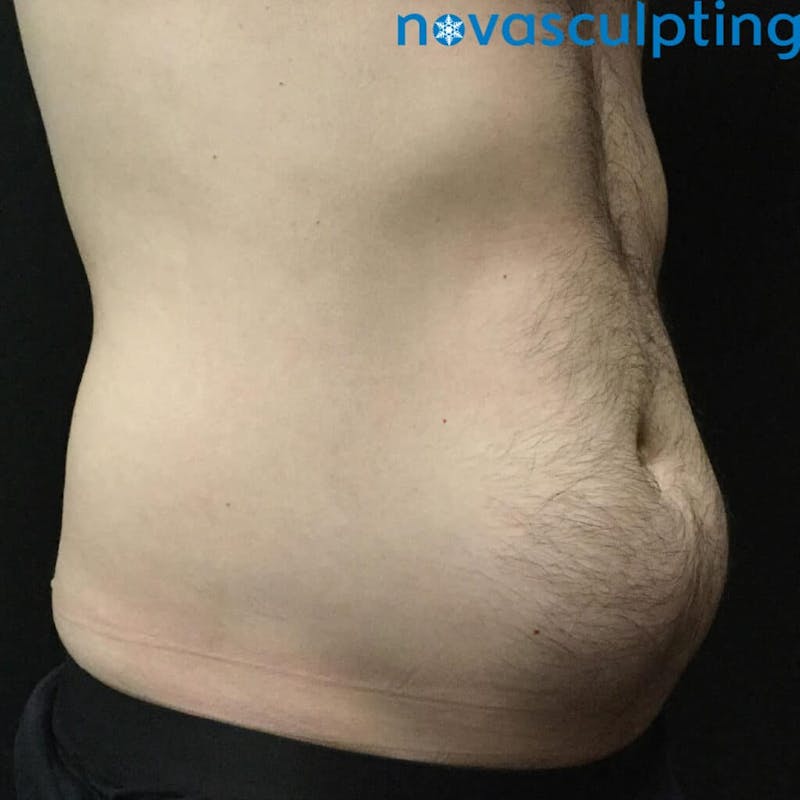 Abdomen Before & After Gallery - Patient 133024851 - Image 1