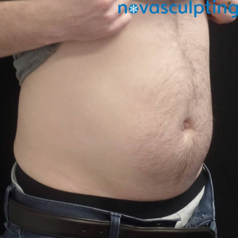 Abdomen Before & After Gallery - Patient 133024851 - Image 2