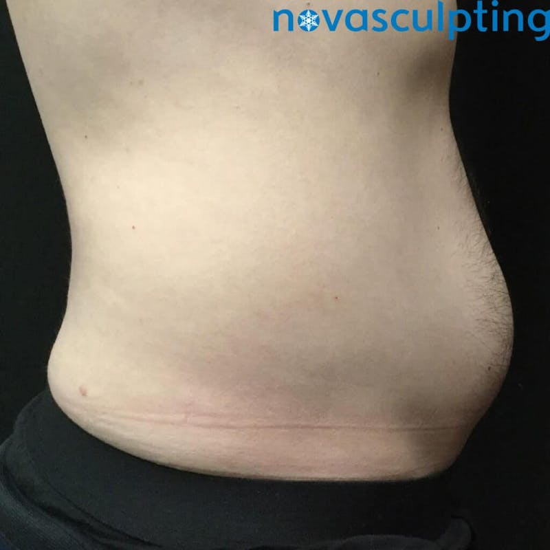 Abdomen Before & After Gallery - Patient 133024851 - Image 3