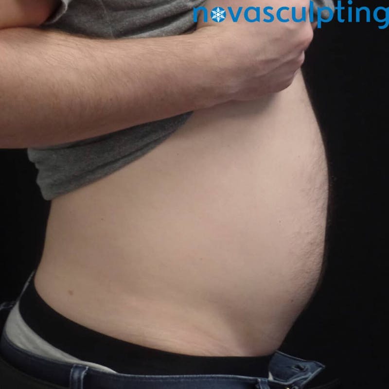 Abdomen Before & After Gallery - Patient 133024851 - Image 4