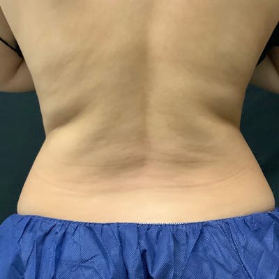 Upper & Lower Back Before & After Gallery - Patient 133024850 - Image 1