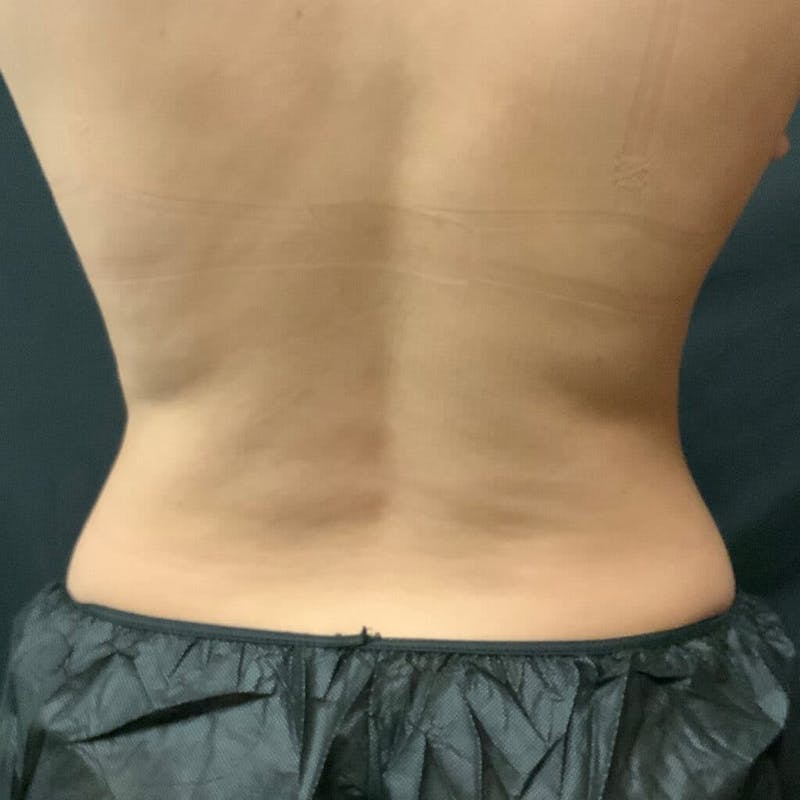 Upper & Lower Back Before & After Gallery - Patient 133024850 - Image 2