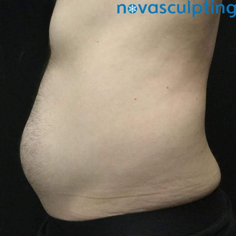 Abdomen Before & After Gallery - Patient 133024851 - Image 5