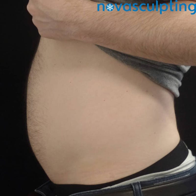 Abdomen Before & After Gallery - Patient 133024851 - Image 6